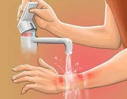 Про першу домедичну допомогу при термічних опіках